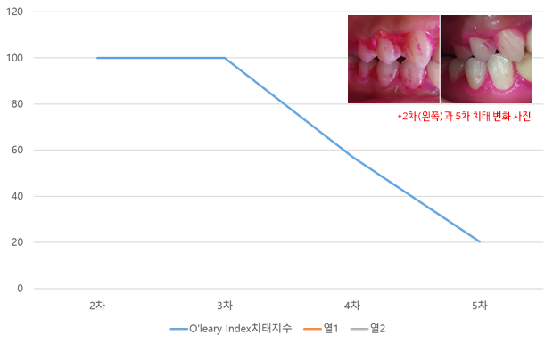 2차부터 5차까지 치태가 꾸준히 줄고 있는 조철웅 씨의 치태지수 그래프