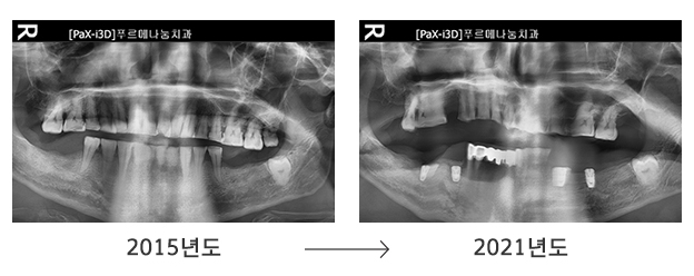남편 A씨의 치아상태 변화