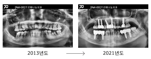 아내 B씨의 치아상태 변화